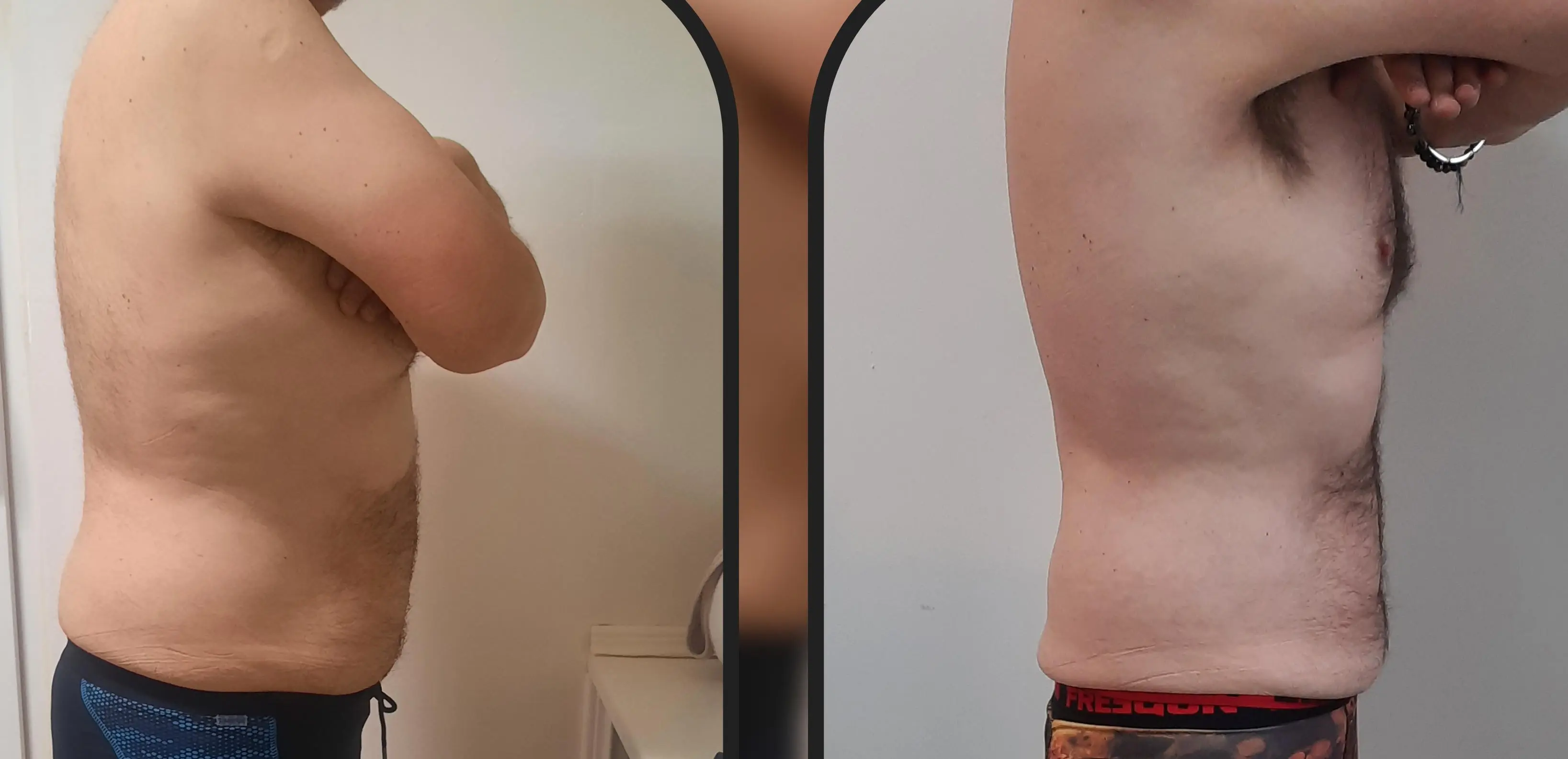 Avant-Après client expertise minceur